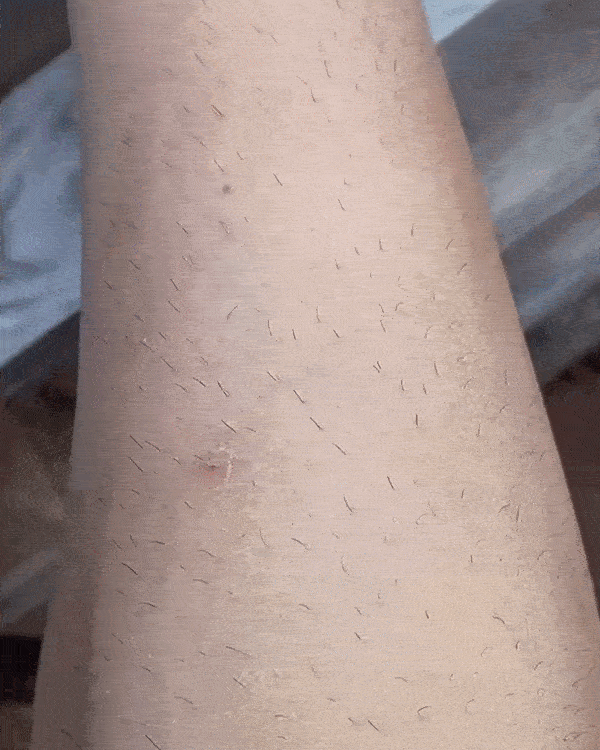 Gomme épilatoire Lumnia™ - Noire